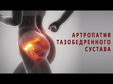 Что нужно знать об артропатии тазобедренного сустава