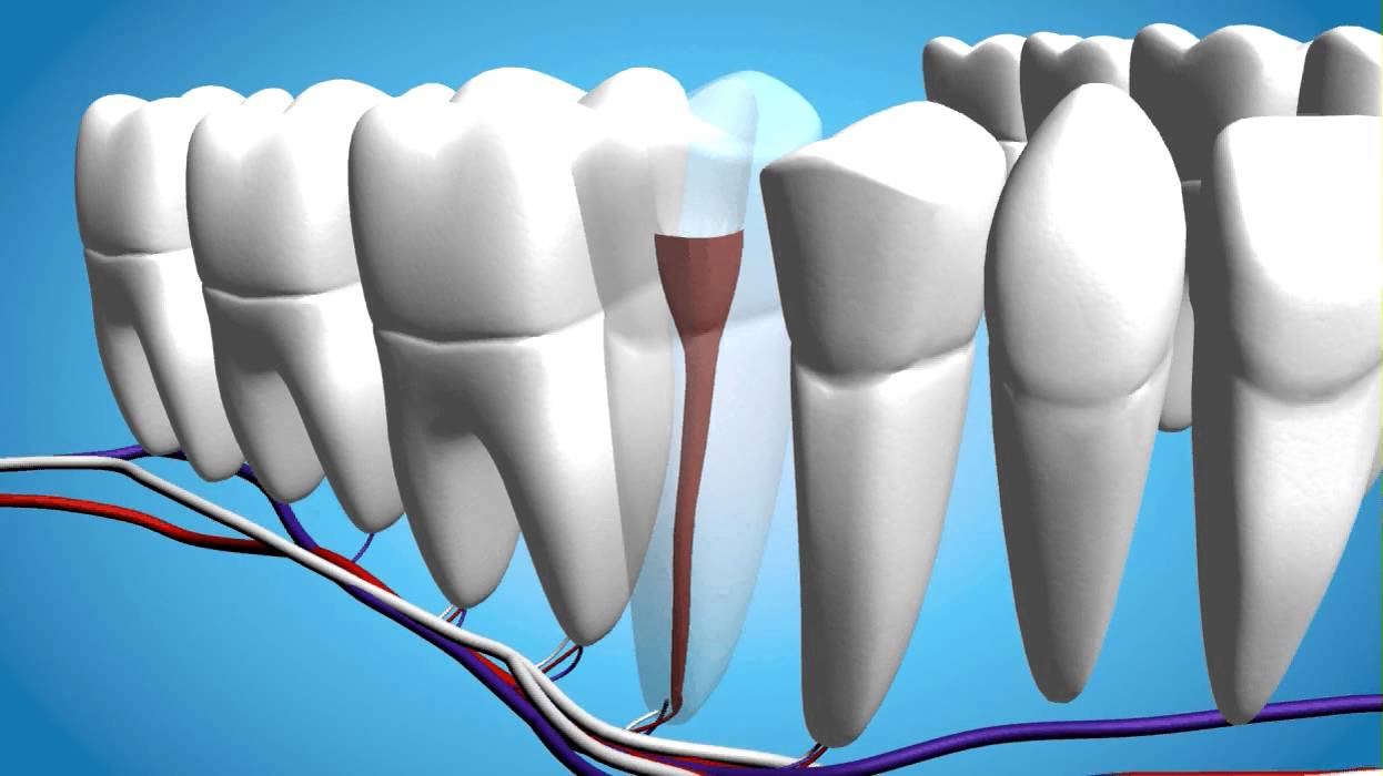 Root canal - Video