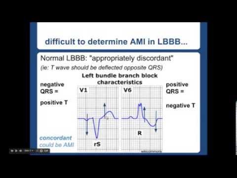 Sgarbossa Criteria - "EM in 5"