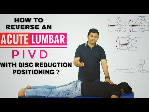 Low back pain due to stiff sacroiliac joint Try Pelvic drop home exercise for quick relief