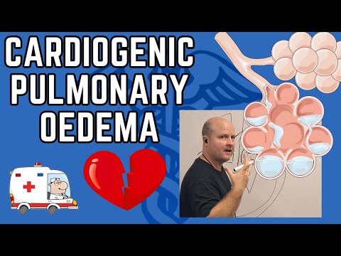Cardiogenic Pulmonary Oedema Explained