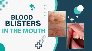 Blood Blisters In The Mouth
