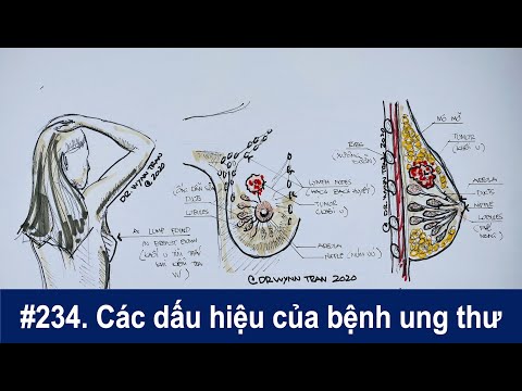 Ung thư có những dấu hiệu nào và các loại BS chữa trị ung thư