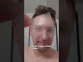 Finding Out What S LIVING IN MY PORES Dermatologist Does Tape Test Demodex Mites Skin Derm
