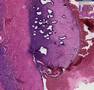 Histopathology Ovary--Endometriosis