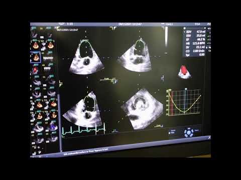 3D Volume analysis of Canine echocardiography using Vivid e95 （犬の心臓の3D解析）