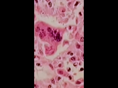Pennsylvania’s measles outbreak shows no sign of slowing