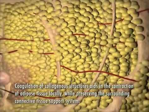 SlimLipo procedure animation