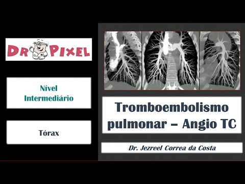 Tromboembolismo pulmonar