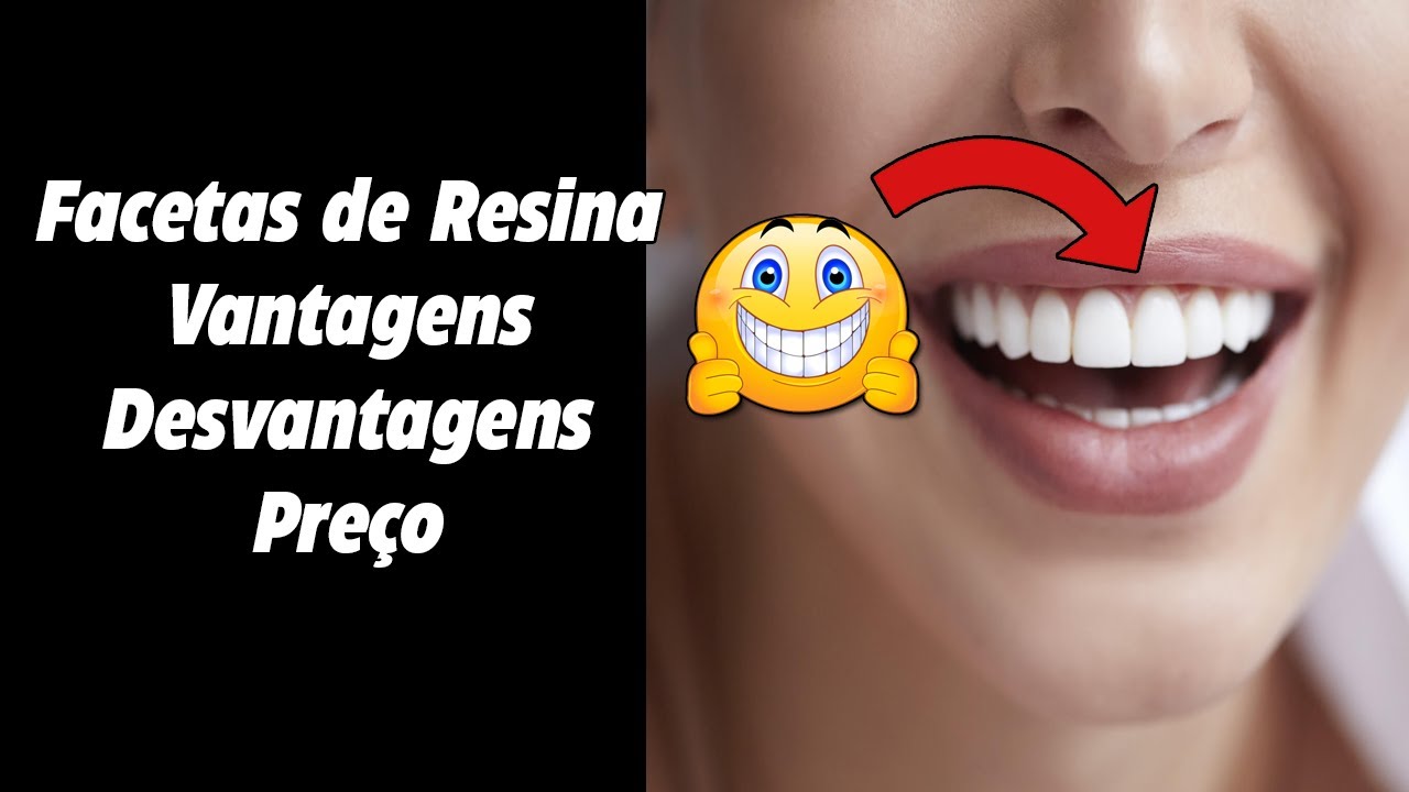 Facetas de Resina - Preço, Vantagens, Antes e Depois #shorts