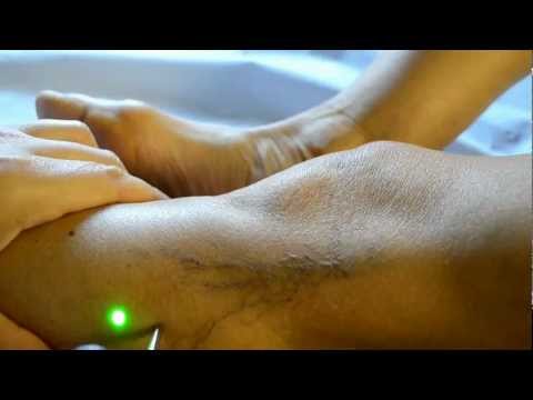 Artrosi sintomi spalla e Il trattamento della colonna vertebrale per il video Neumyvakin