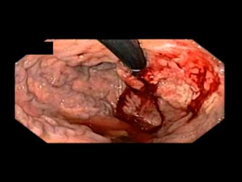 Adenocarcinoma gástrico