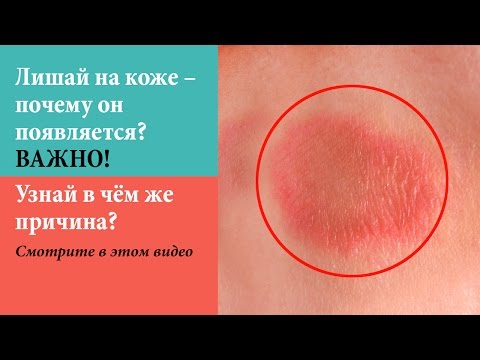 Ахромин мазь от пигментных пятен Из за чего на лице появляются пигментные пятна и как это лечить