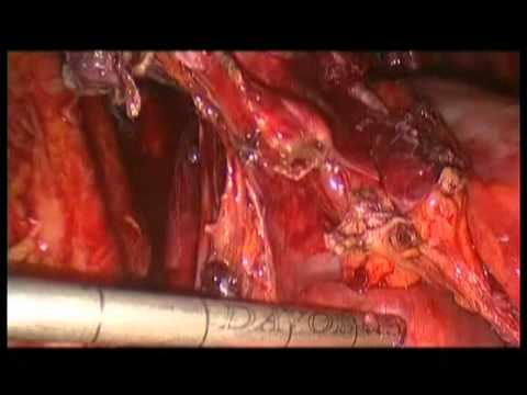 Tumor Mass Reduction In Advanced-Stage Cancer Of The Ovaries-Laparoscopic Approach