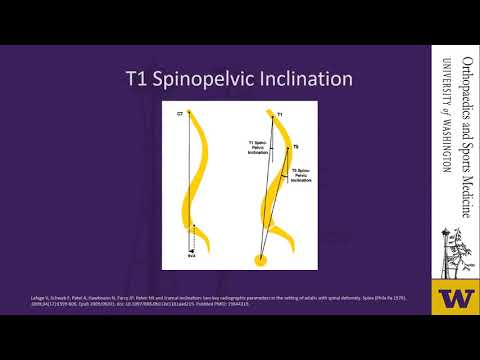 Proximal Junctional Kyphosis after Adult Spinal Deformity Treatment