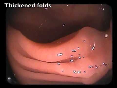 Thickened Folds - A Sign of Submucosal Invasion