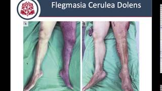 Trombosis Venosa Profunda