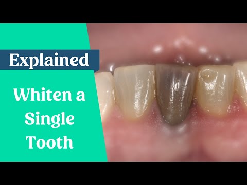 How to whiten a single dark tooth