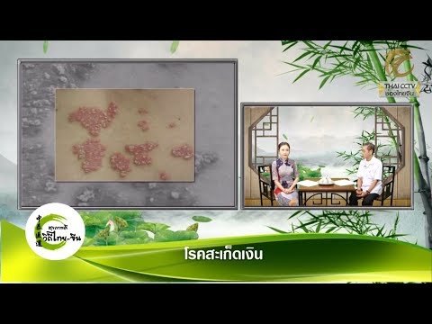 ครีมสำหรับผิวสะเก็ดเงินราคาหมวก บาดแผลจากภาพกลาก