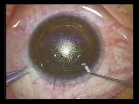 Vedere după operație glaucom