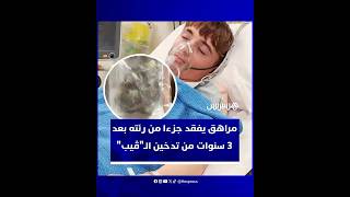3 سنوات من تدخين السجائر الإلكترونية.. استئصال جزء من رئة مراهق نيوزيلندي بعد تعفنها thumbnail