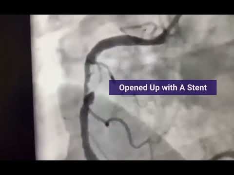 Primary Angioplasty in Myocardial Infarction. #pami … RCA Thrombotic lesion