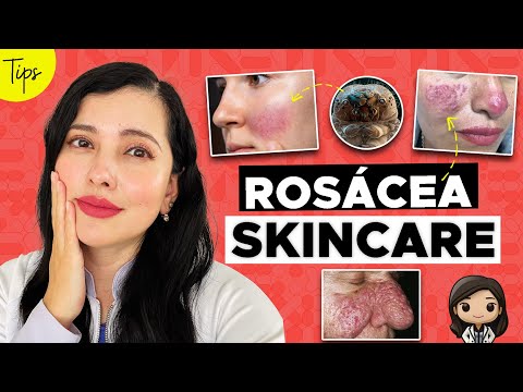 DO YOU HAVE ROSACEA? THIS IS WHAT YOUR SKINCARE SHOULD BE LIKE 👩🏻‍⚕️👌🏻🤝🏻