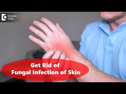 FUNGAL INFECTION OF SKIN. Causes, Symptoms and Treatment - Dr. Amee Daxini | Doctors' Circle