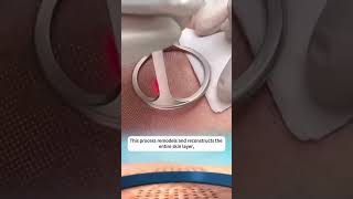CO2 Laser in Poipet