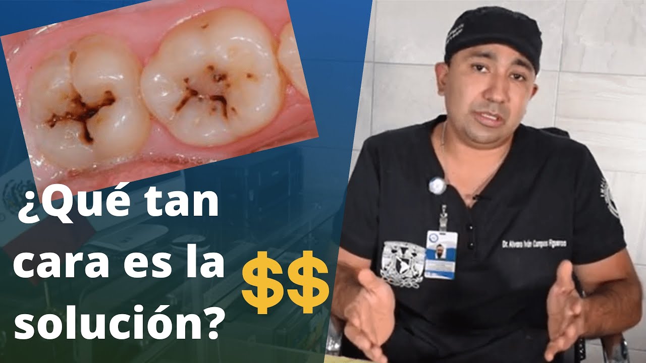 Tratamiento de caries sin dolor | ¿Qué tan costoso es quitar una caries 2021