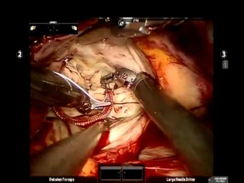 Robotic Assisted Mitral and Tricuspid Valve Repair