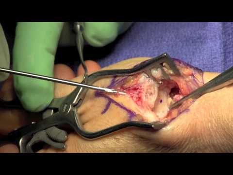 Artroplastyka stawu nadgarstkowo - śródręcznego kciuka