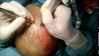 preview picture of video 'Hair Transplant Surgery in Delhi - FUE Method 5000 Grafts in Single Sitting'