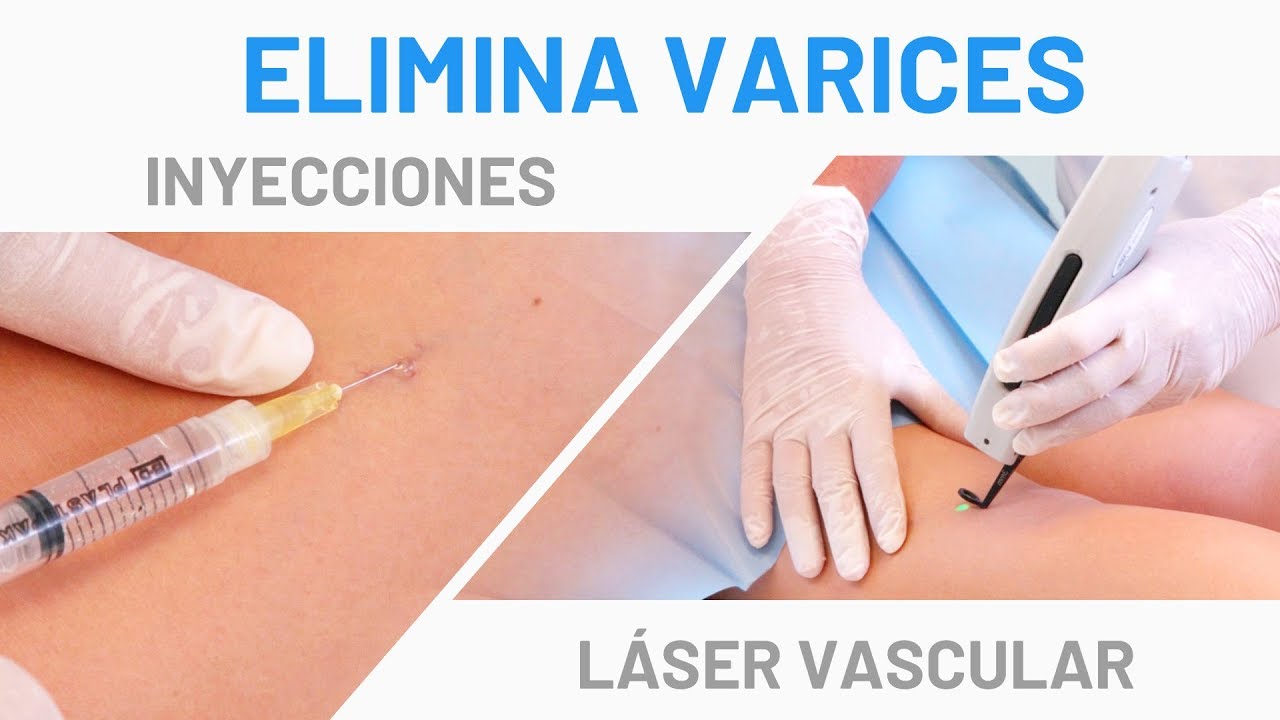 Watch Varices en las Piernas: Tratamiento Láser Vascular + Escleroterapia Now Varices en las Piernas: Tratamiento Láser Vascular + Escleroterapia