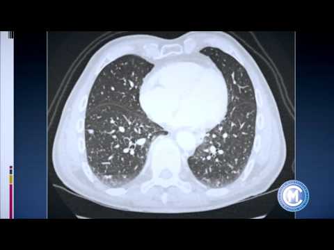 Dolore al ginocchio in osteocondrosi Dolorante bassa della schiena durante il sonno
