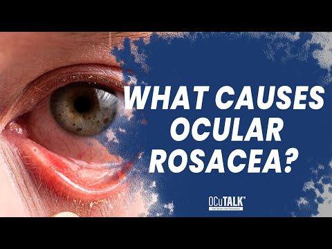 What causes Ocular Rosacea? Dr. Greider Sideris Explains