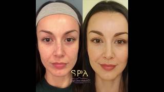 Botox Before and After Compilation