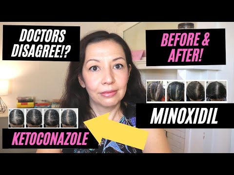 WILD RESULTS 😳 FROM KETOCONAZOLE SHAMPOO? DOES IT REALLY WORK ON HAIR LOSS? THIS STUDY PROVES IT?