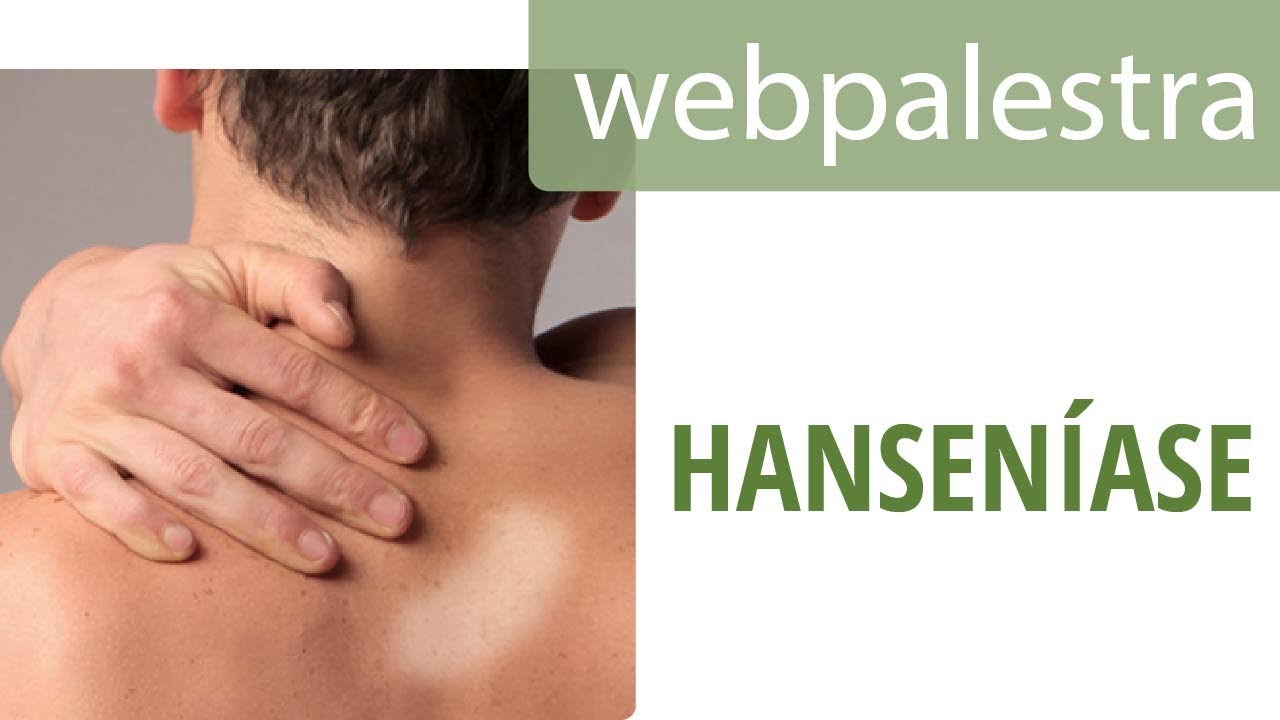 Webpalestra - Hanseníase: diagnóstico precoce na ABS