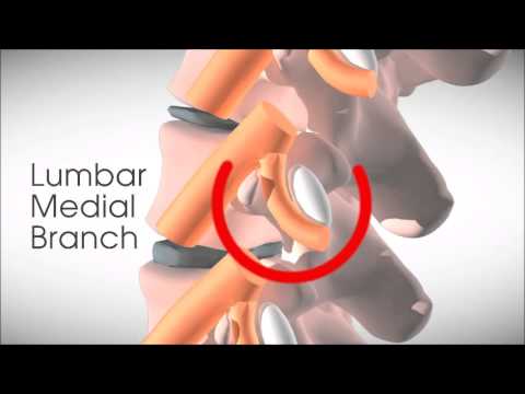 Lumbar medial branch injection