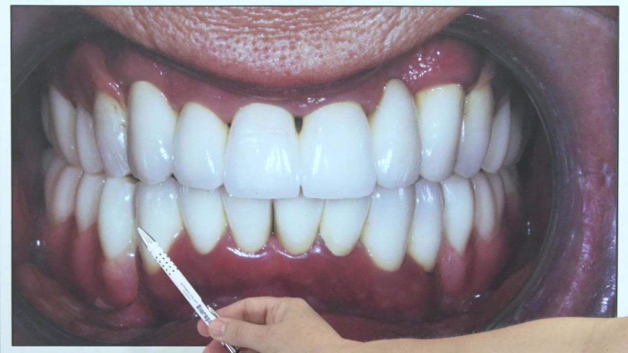 Protezy bezklamrowe – luksusowe rozwiązania przy częściowym bezzębiu - studium przypadku (21)