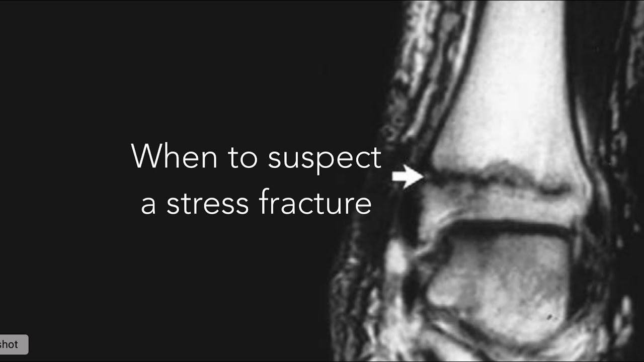 When to suspect a stress fracture