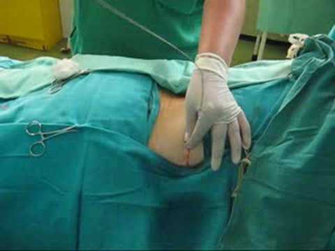 นวดสำหรับการเสริมเต้านม ระลอกในหน้าอกหลังจาก mammoplasty