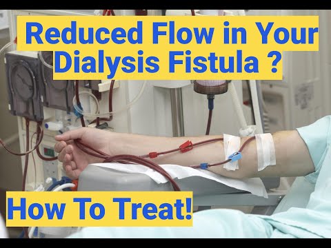 How to Treat Reduced Flow Issues in Your Dialysis Fistula | Dr. Pushan Sharma