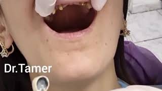 Metal keramika dişlər