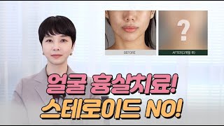 얼굴 지방흡입 부작용, 흉살 치료 전후 사진 후기!