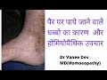 Homoeopathic treatment of Schamberg disease/homoeopathic medicines for dark spots on leg.