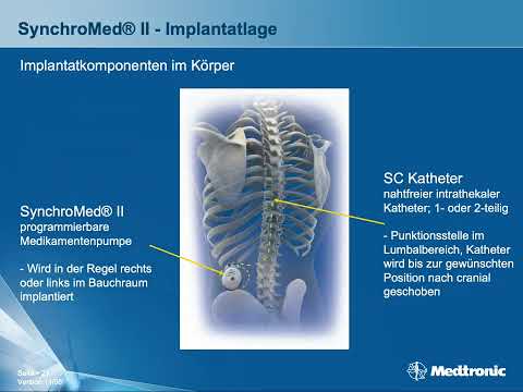 Dr. Georgios Matis - Neuromodulation - Intrathekale Arzneimittelinfusion bei chronischem Schmerz