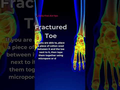 :🦶 Broken a Toe? Here’s How to Protect It Until You Get Medical Help! 🩹