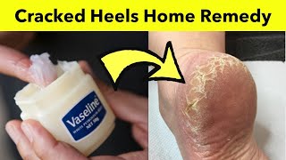 How to Fix Cracked Feet in Winters - Natural Remedy to Get Rid of Cracked Heels
